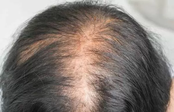 آلوپسی اندروژنتیک با پی آر پی